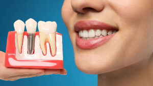 Dental Implant Tedavisi Hakkında Bilgi  